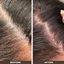 YeastDefense™️ Seborrheic Scalp Solution Double Bundle