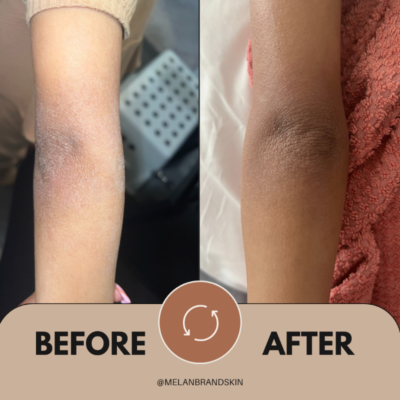 MelanMoisture Extreme Cream