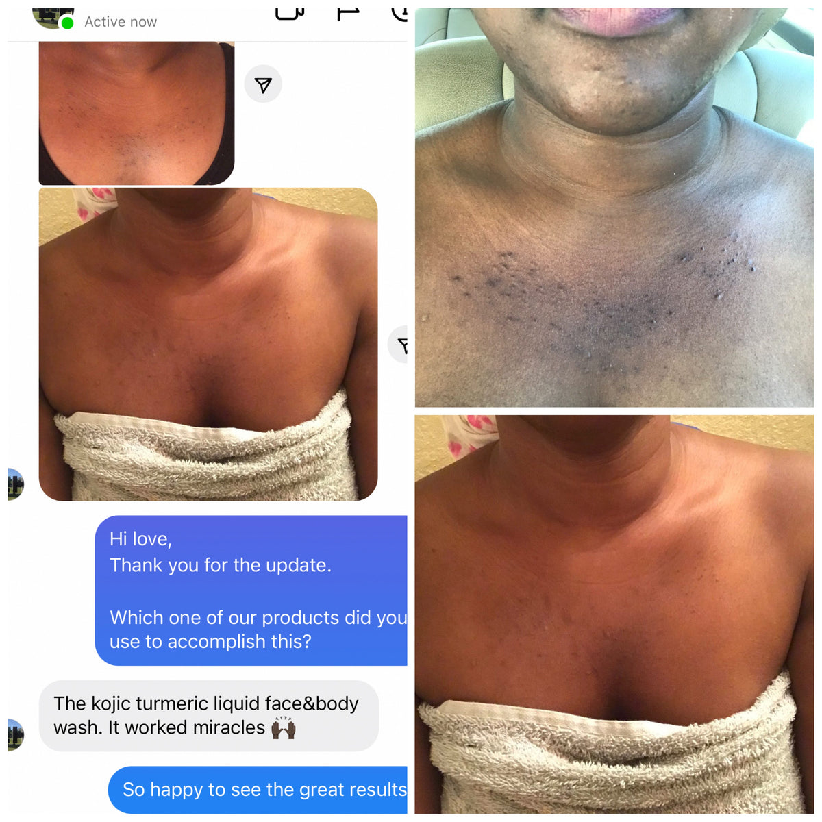 KoJic & Turmeric Even skin tone  — Extra strength Brighten kit