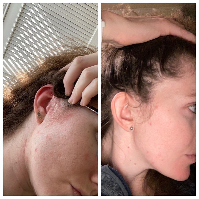 Prebiotic Facial Solution: Liquid AHA + BHA Serum | YeastDefense®️